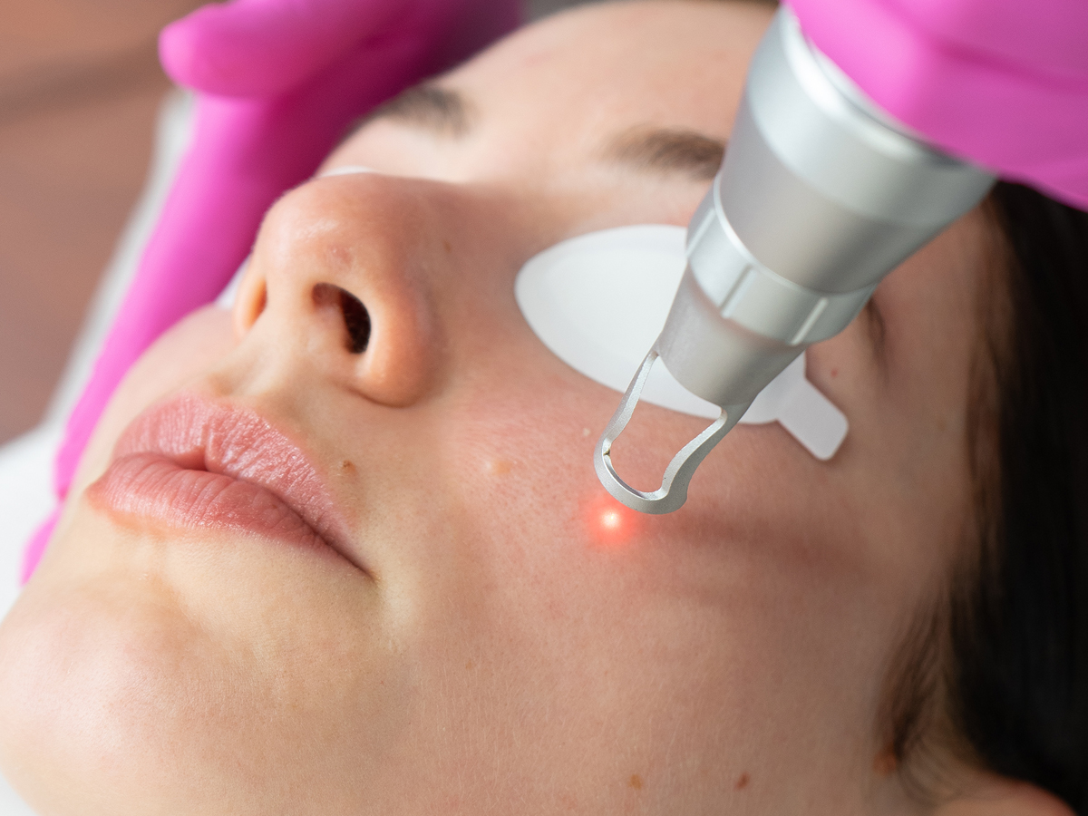 A woman's face with a laser removing pigmentation in Sydney.